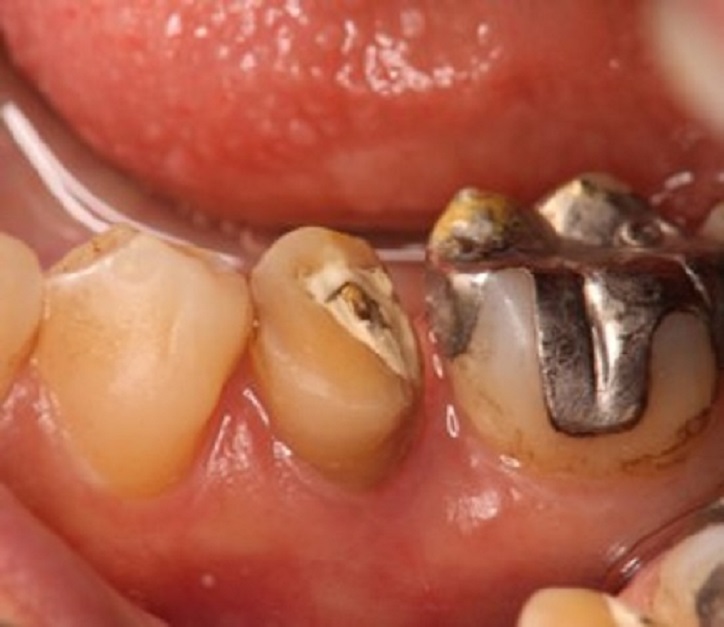 エムドゲインを用いた歯周組織再生療法の症例