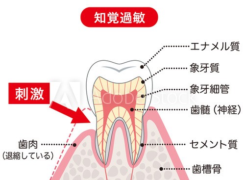 知覚過敏について