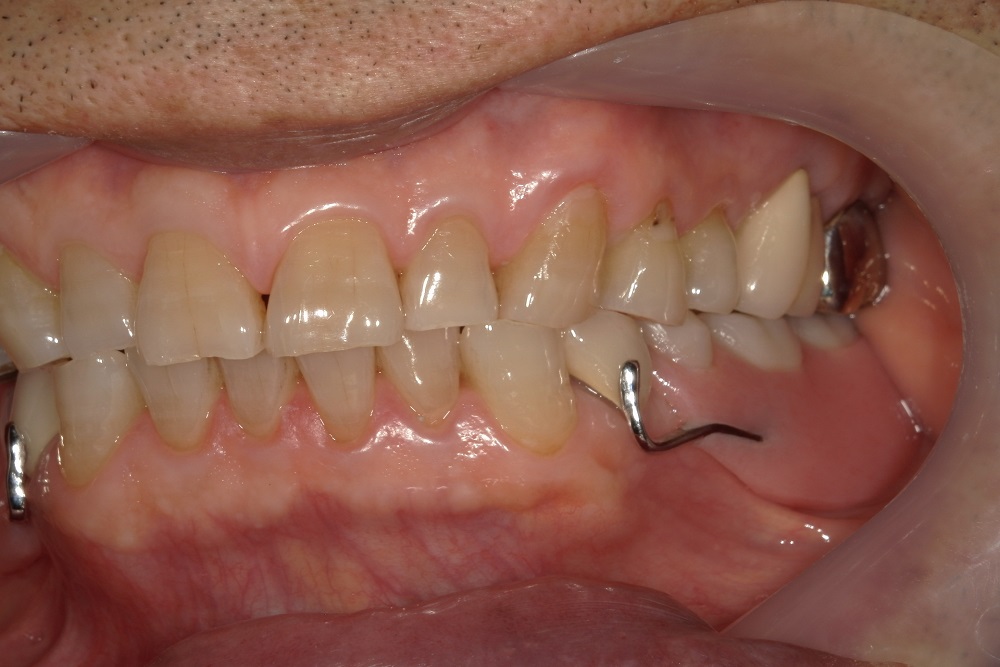 被せ物・部分義歯の作成