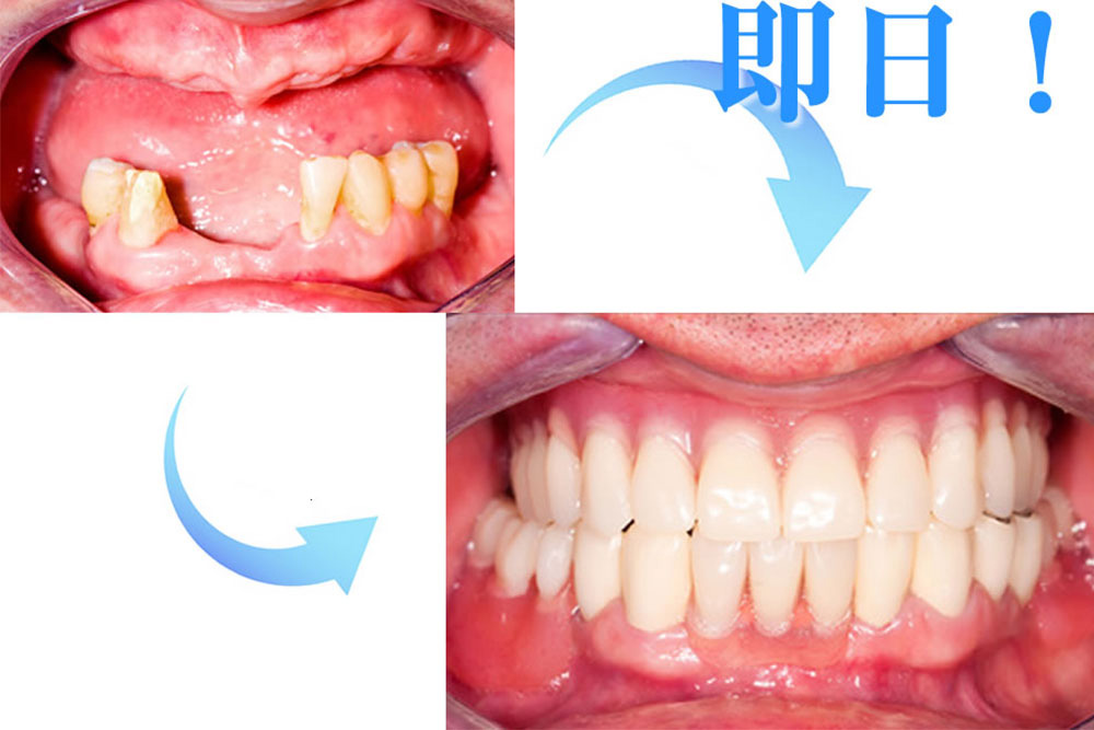 抜歯即時埋入法