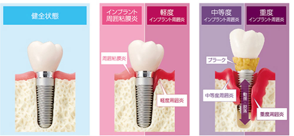 インプラント周囲炎