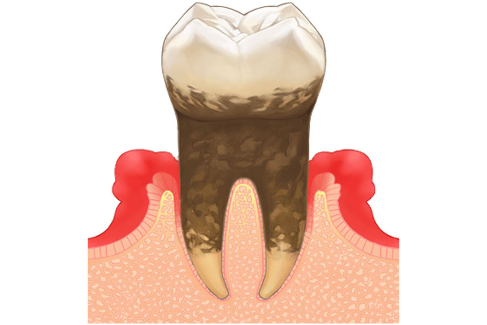 智歯周囲炎